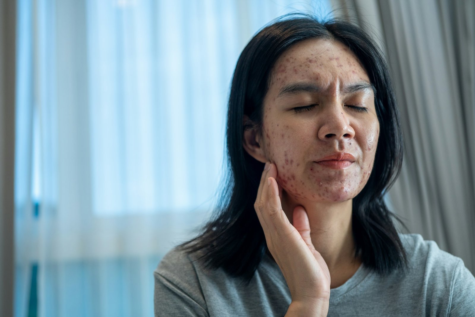 Acne on face because the disorders of sebaceous glands productions. Acne or a Cosmetic