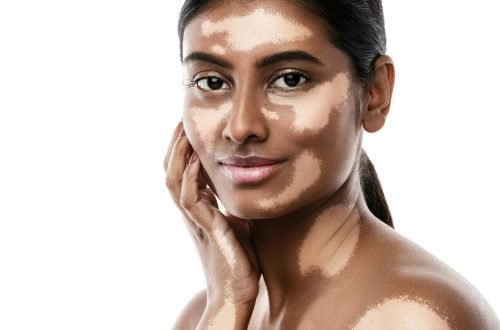 Beautiful South Asian woman with vitiligo skin disorder against white background