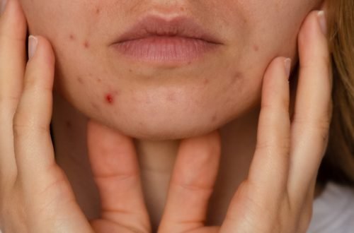 Unrecognizable woman showing her acne on face. Banner Close-up acne on woman's face with rash skin