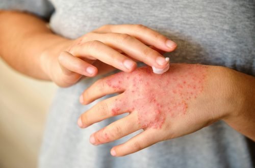 Woman applying ointment or moisturizing cream in the eczema, atopic dermatitis.